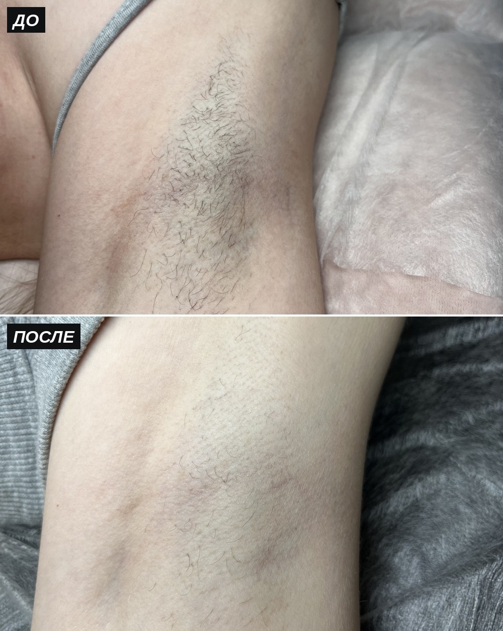Электроэпиляция подмышек, до и после — Студия красоты Алины Хусаиновой
