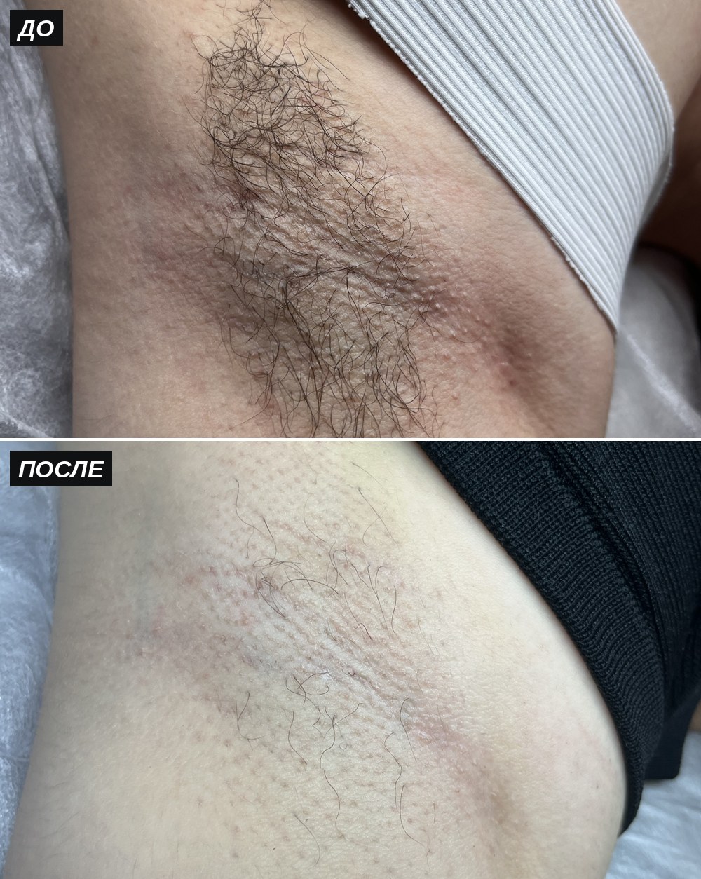 Электроэпиляция подмышек, до и после — Студия красоты Алины Хусаиновой