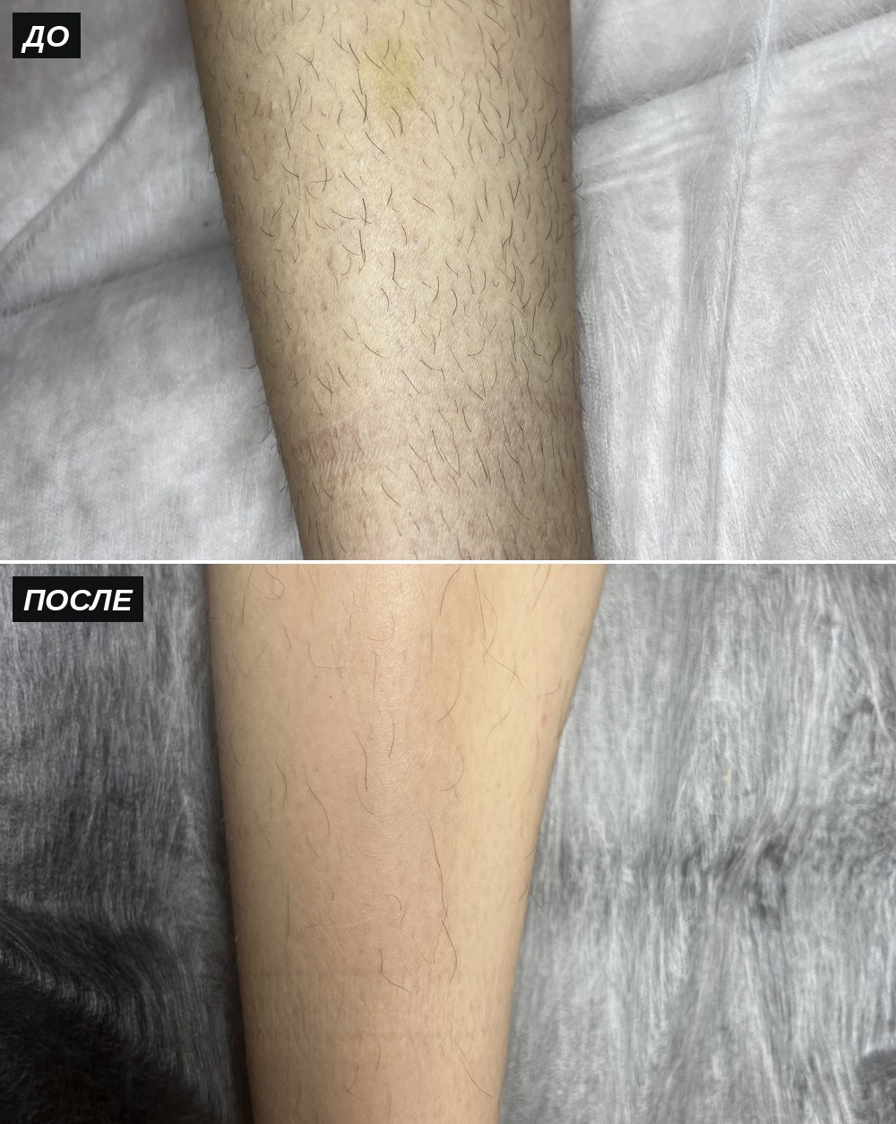 Электроэпиляция ног, до и после — Студия красоты Алины Хусаиновой